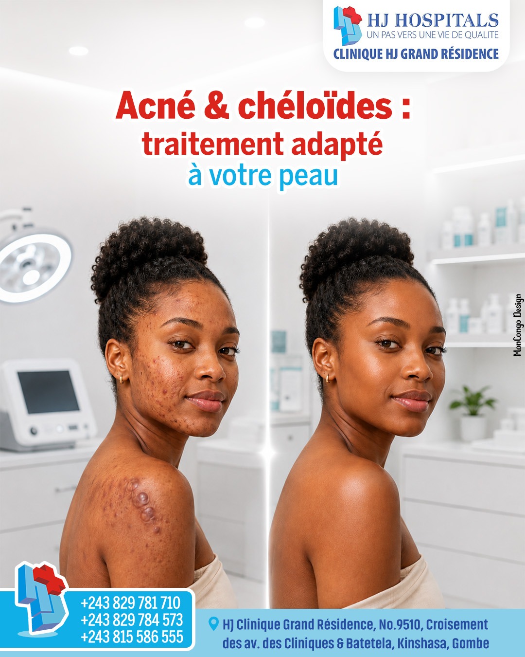 Acné & chéloïdes : un traitement adapté à votre peau